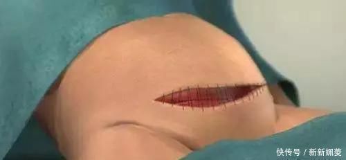 妈妈|剖腹产到底是怎么“剖”的一组图看清全过程,每个妈妈都是超人