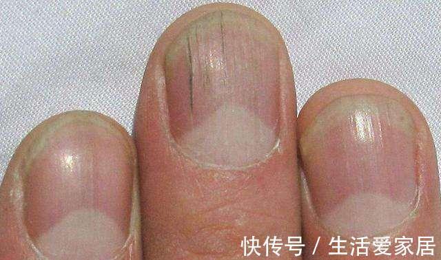 指甲|肝脏不好，手上会发出4个信号，若没有，说明肝脏还算健康