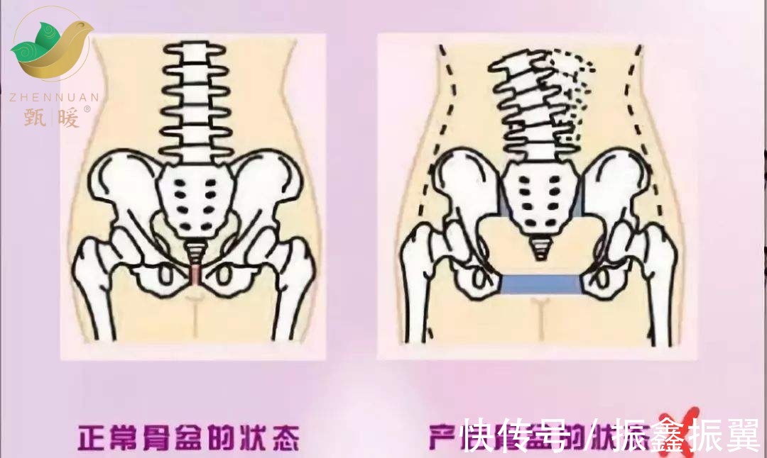 韧带|为什么要做骨盆修复?是交智商税?甄暖知识分享