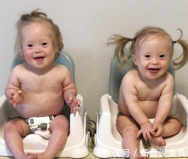 唐氏双胞胎|妈妈生下唐氏双胞胎姐妹,并不轻言放弃,唐宝都有一张相同的脸