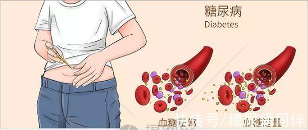 胰岛功能|糖尿病人降血糖的4个方法,用起来血糖更好