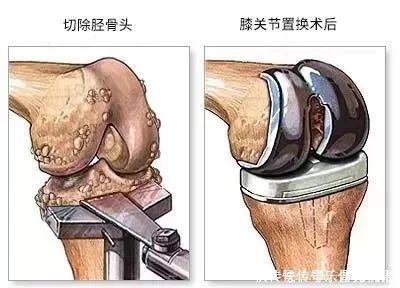膝盖|夫妻双双手术换掉膝盖！罪魁祸首竟是坚持10年的“好习惯”！