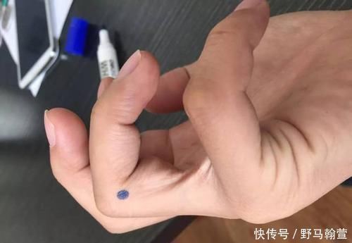 头疼|手上有四个穴位,可疗一切头疼,一起来了解一下吧