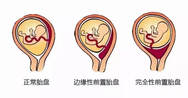 胎盘|孕妇的肚子不能乱摸，尤其是以下3种情况，孕妈自己也要管住手！