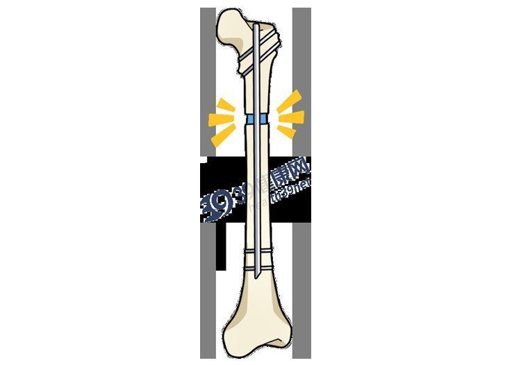 髓内针|做了断骨增高术的人，最后都怎样了？一旦失败，这3个后果在等着