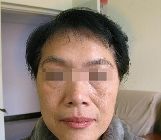 拉皮手术 拉皮术后即刻,47岁的我找回了消失已久的“少女感”!