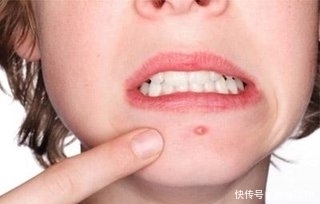 痘痘肌饮食需要注意什么?