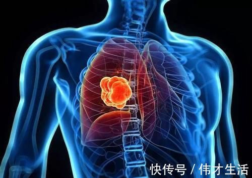 脑卒中|脑梗死预防大于治疗!医生坦言:注意几点就可轻松预防