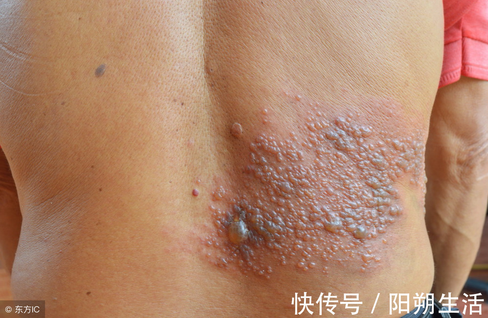 验方|秋冬“缠腰蛇”多发,会传染,试试民间小验方,少遭罪、好得快!