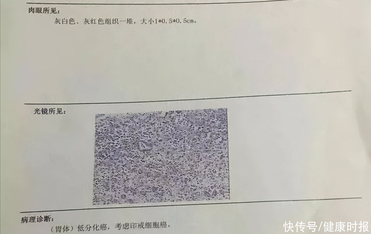 病理|为何做了三次胃镜才发现胃癌！这个病例给所有人敲响警钟