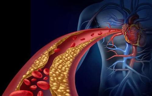  改正|血管堵塞或与这5个原因有关！若不及时改正，血管堵塞越来越严重