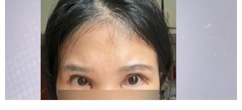 手术 28岁女子做双眼皮手术“眼睛变成白眼” 老公天天闹离婚