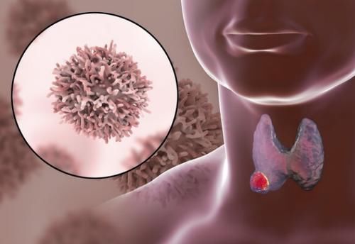 皮肤瘙痒|43岁大姐皮肤过敏，确诊甲状腺癌，医生：身体1处发痒，趁早检查