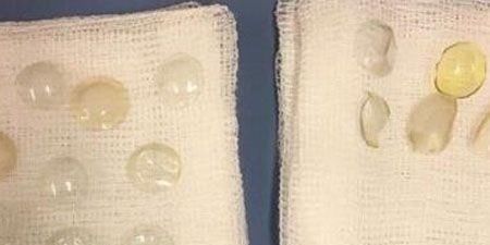 路易斯|女子眼睛不舒服，手术取出27枚隐形镜片，直称“无感觉”