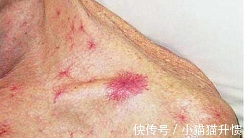 扁鹊内经|肝若硬化,头先知?头部若出现5个异常,建议:去医院做肝CT检查