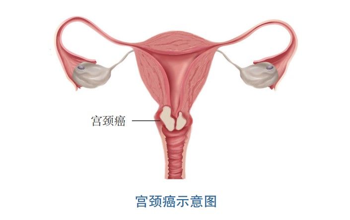 宫颈癌|女性不同年龄段应该多久做1次宫颈癌筛查？宫颈癌疫苗又该如何选择？