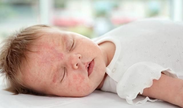 药物|婴儿得了湿疹就不能洗澡?错,关于它的5大谣言要认清,别再上当了