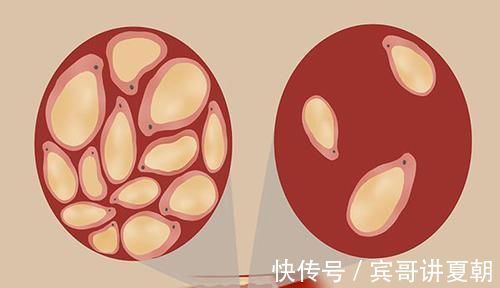 忠告|过来人的忠告：甘油三酯3.1，改掉三个习惯，血脂也能悄悄降