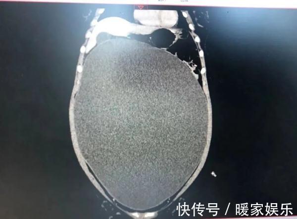 囊肿|13岁女生肚子隆起爬满“妊娠纹”,照完CT妈妈当场吓懵