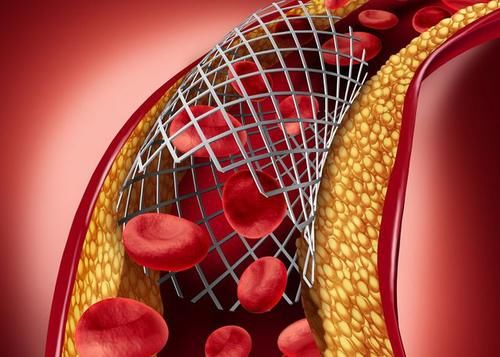 1种“零食”，正在悄悄堵塞血管，专家提醒：40岁后应少吃