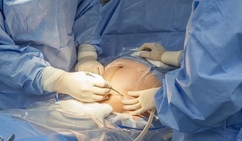 顺产|女人可以做几次剖腹产不是三次和五次,医生不要超过这个数