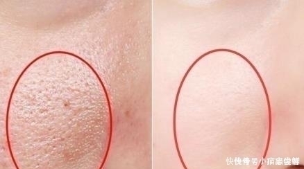 柠檬汁|抿紧下巴后突起的“白疙瘩”,千万要注意,这是螨虫的真身吗?