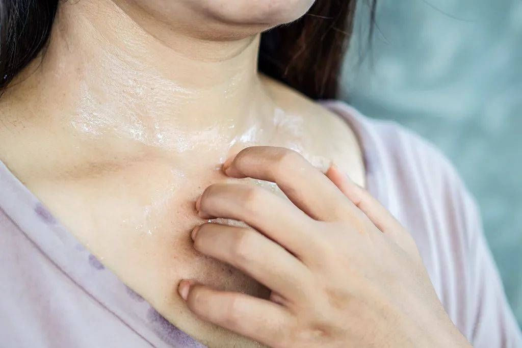 斂汗|夏天出汗是排毒？這幾個部位出汗預示著大麻煩