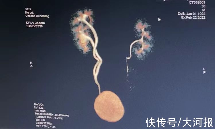 泌尿外科|郑州一男子长了三个肾？专家：这是常见病会遗传，还有人“四个肾”