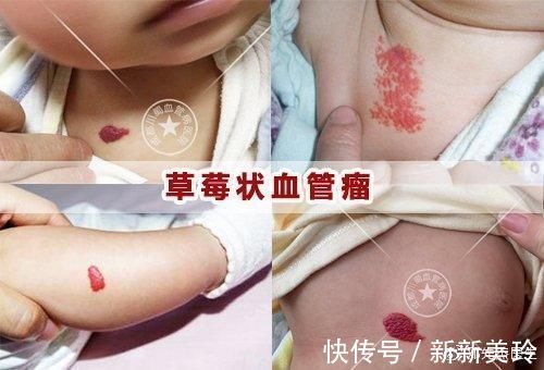 胎记|胎记需要治疗吗?医生告诉你,这些胎记不治疗真的不行!