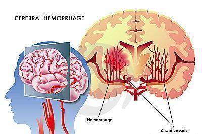 后遗症|“脑溢血”近身时，身体会出现4种“怪象”，熟记一个也很不错