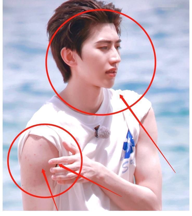 蔡徐坤参加跑男,大夏天穿羽绒服引关注,手臂上的红疹却让人心疼