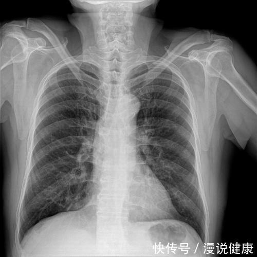 发病率|肺癌只与吸烟有关吗？这3个因素害肺不浅，希望你早了解