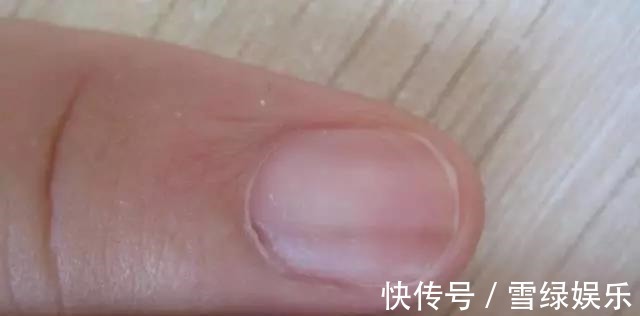 癌症|指甲上有黑线,可能是最恶的癌症,医生教你怎么办