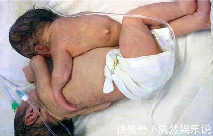 医生|父母开心迎来双胞胎,看到孩子的下半身,妈妈失声痛哭