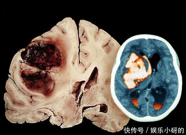 情况|什么情况下,一个普通人会经历“一生中最剧烈的头痛”?