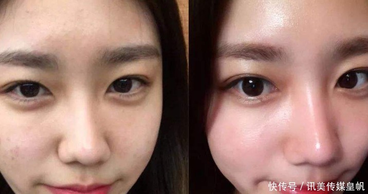 黑头|鸡蛋清能去黑头?医生提醒:2招轻松搞定草莓鼻烦恼