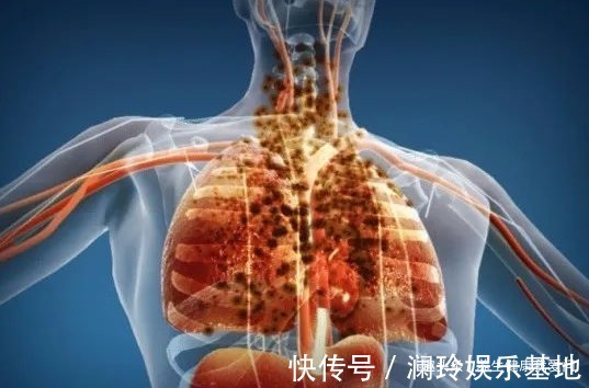 肺部|呼吸科主任:开水里面扔一把,放开去喝,冲走烟毒,肺一天天变净