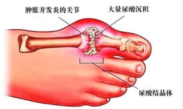 尿酸是怎么来的? 常见的以下蔬菜水果, 几天高尿