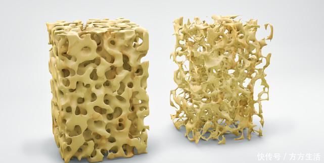 骨质疏松“祸根”找到了，骨科主任这4物再多吃，骨头容易脆如沙