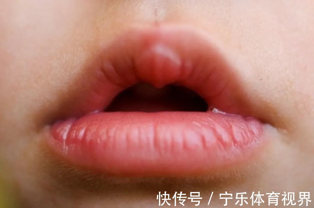 不良习惯|孩子嘴唇干裂、起皮还出血怎么办?医生教你正确护理,比喝水管用