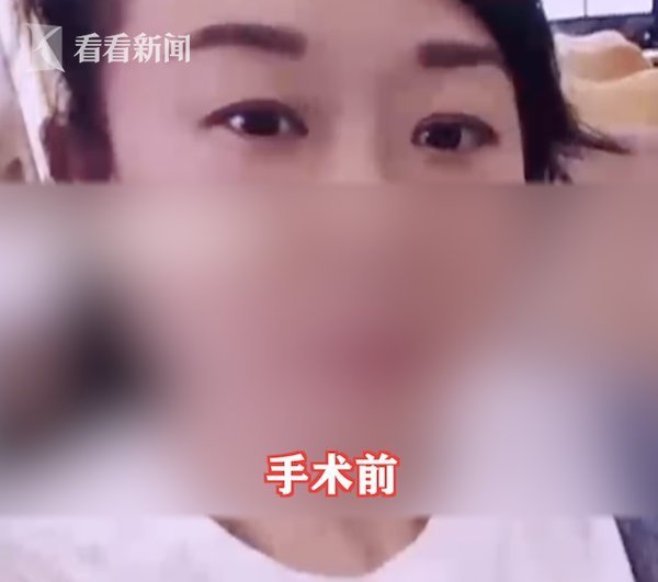 离婚|女子花2万割双眼皮3个月没消肿 老公要离婚