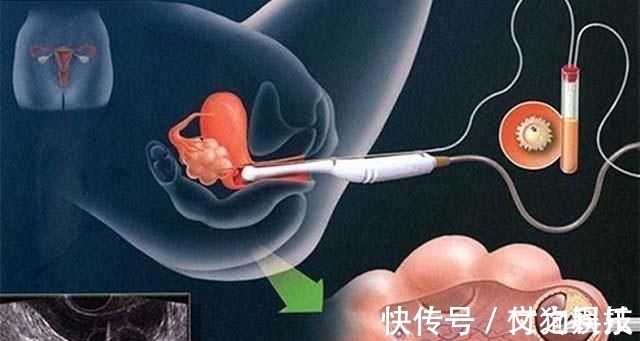 郑女士|国内首例“试管婴儿”,如今已32岁,生活状况在众人意料之外