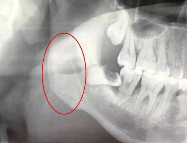 手术治疗|注意!智齿发炎“放倒”男子,拔牙后住进ICU