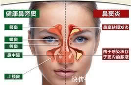 慢性肥厚性鼻炎|入秋转凉鼻炎发作,专家秘诀不妨一试!见效极快