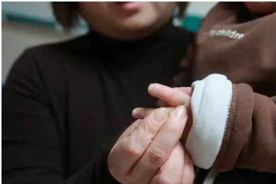 汗腺|3岁女宝天生无汗腺,一年四季靠空调“续命”,每月电费上千元