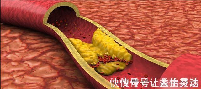 血脂|高血脂的“祸根”不只是盐,劝告3物最好少吃,不然血脂飙升