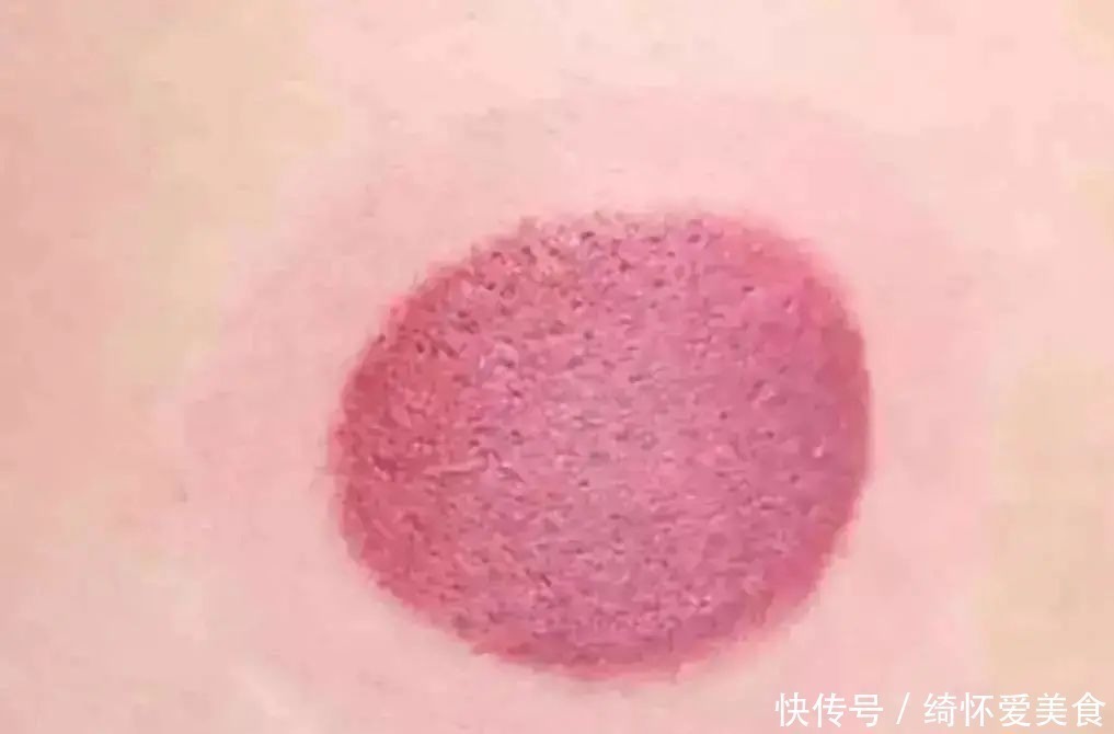 湿气|拔火罐到底吸出来是湿气,还是毒素?答案或和你想的不同