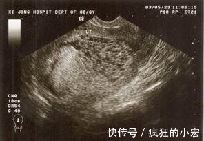 刘芳|女子待产旬月因一口凉水发现未孕,医院检查结果更让人崩溃恐惧