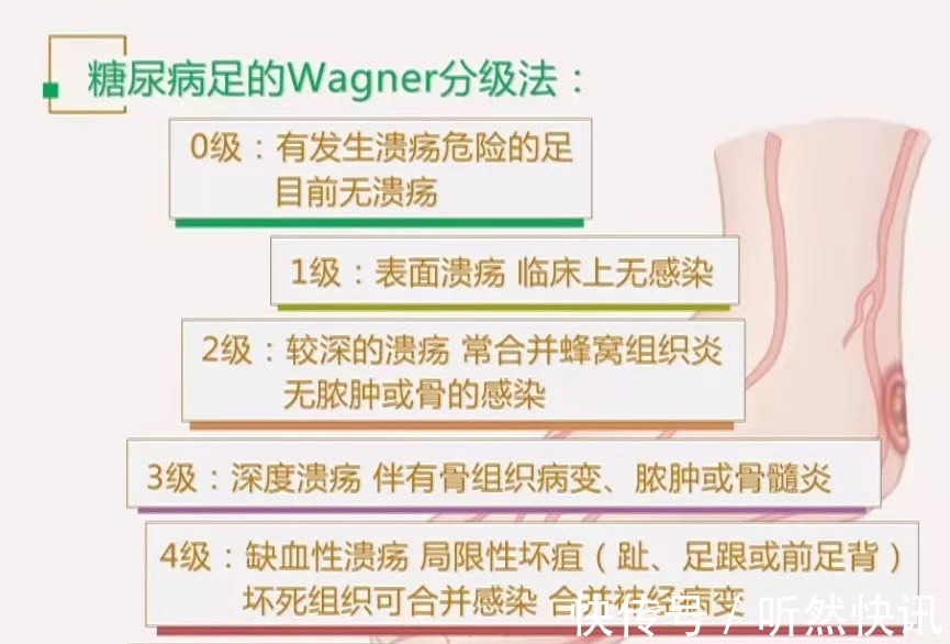 间歇性跛行|糖尿病足是每个糖友的“噩梦”！医生提醒出现4个症状就该警惕