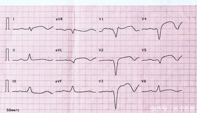  做过心电|有医生看一眼心电图就说冠心病，有医生却说心电图没用？实情是？